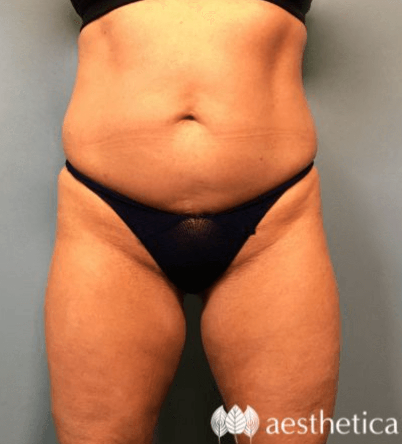 Tummy Tuck before photo