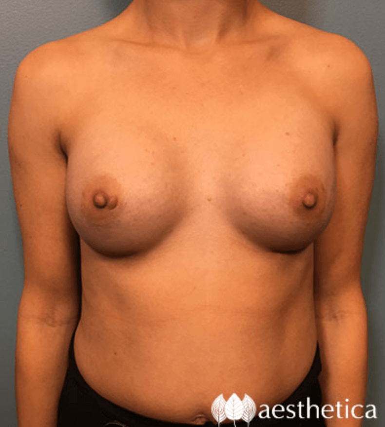 Breast Augmentation result at Aesthetica Plastic Surgery