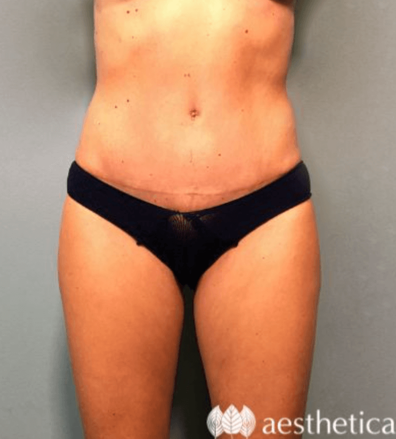 Tummy Tuck result at Aesthetica Plastic Surgery