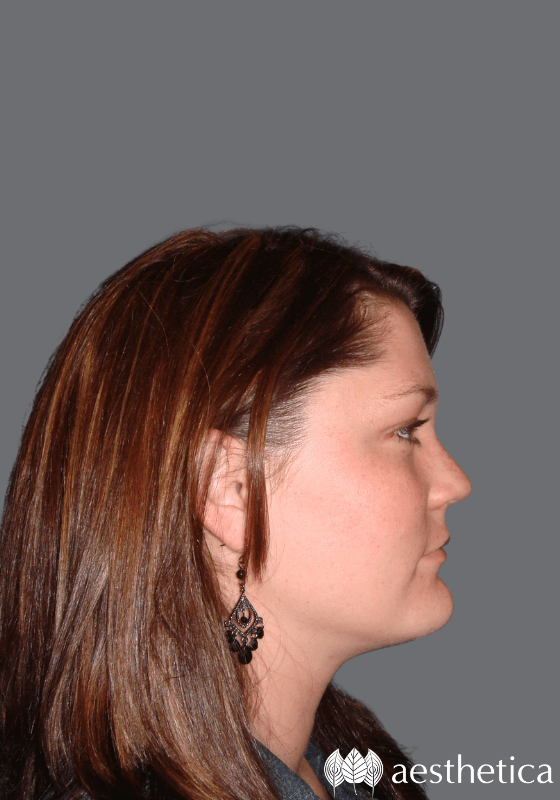 Aesthetica Plastic Surgery neck lift after — Lindon, UT