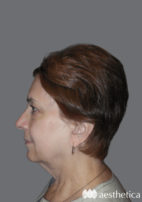 Facelift before photo