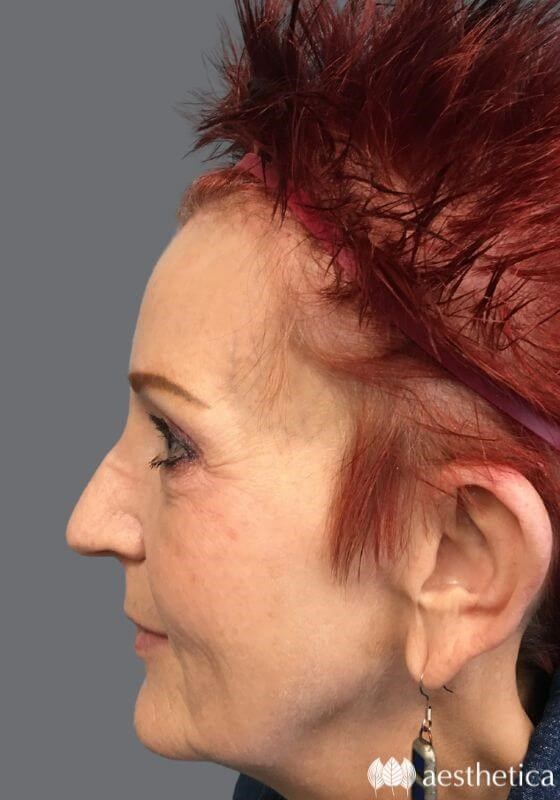 Brow Lift result at Aesthetica Plastic Surgery