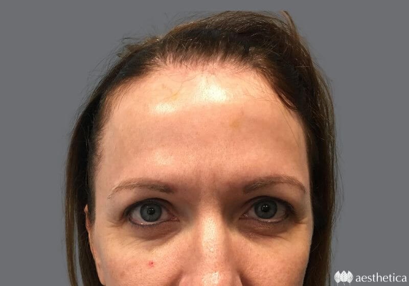 Blepharoplasty before photo