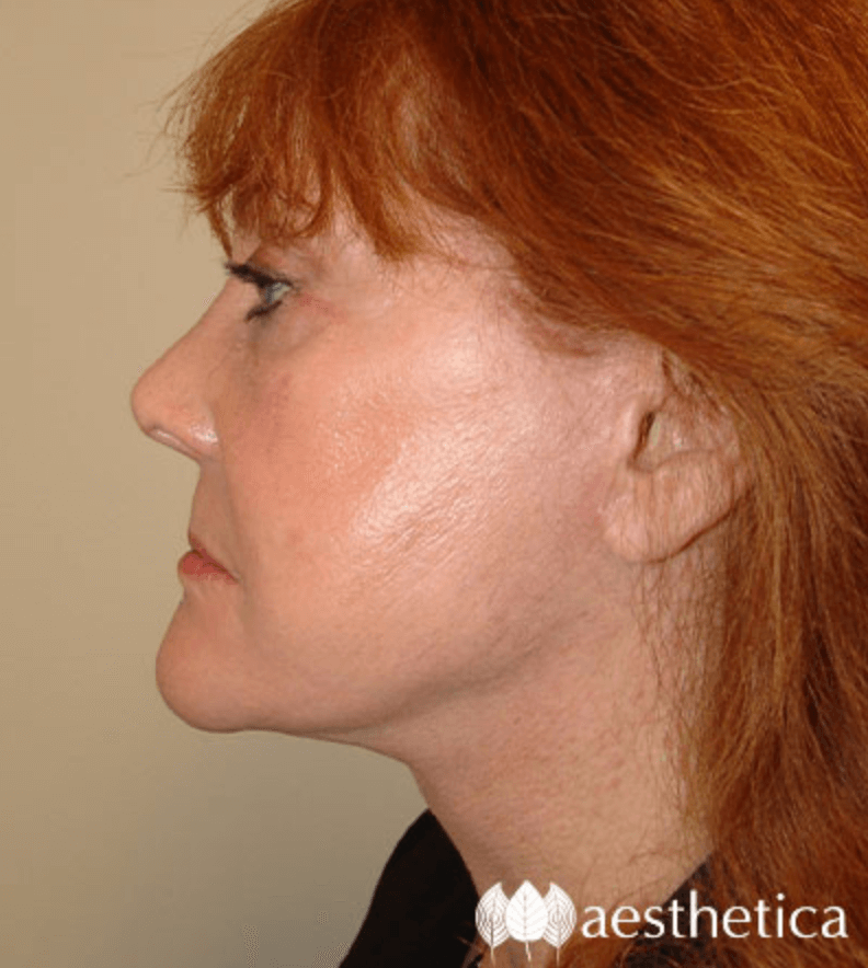 Facelift result at Aesthetica Plastic Surgery