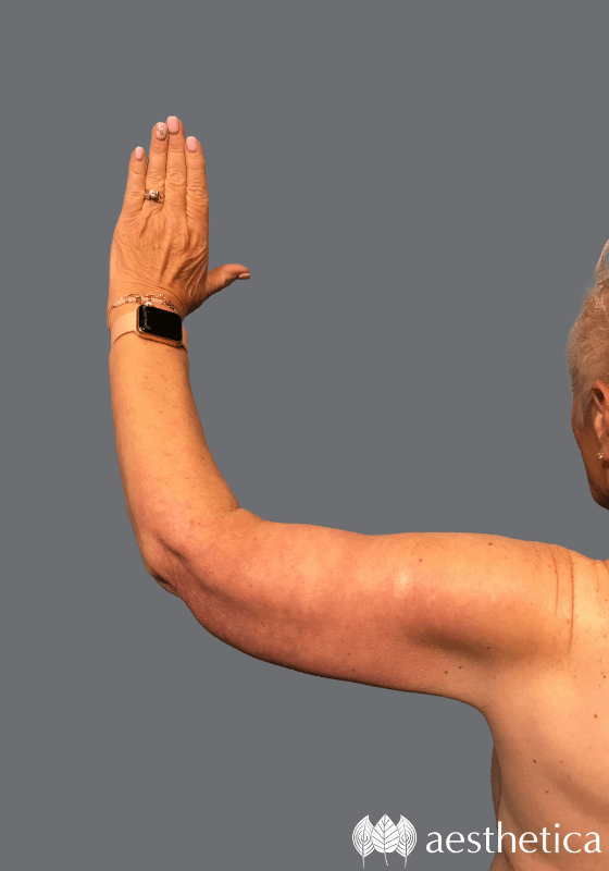Arm Lift result at Aesthetica Plastic Surgery