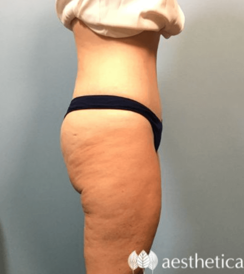 Mommy Makeover result at Aesthetica Plastic Surgery