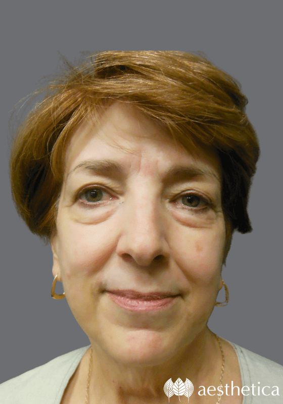 Facelift before photo