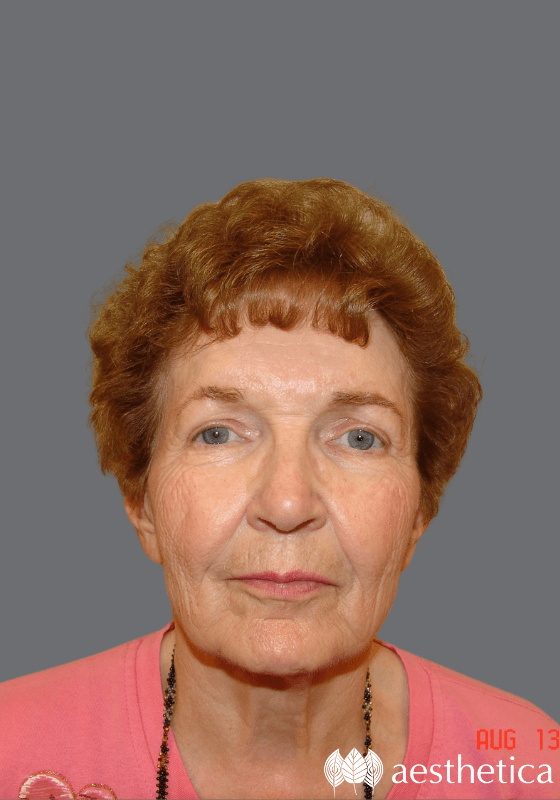 Facelift before photo
