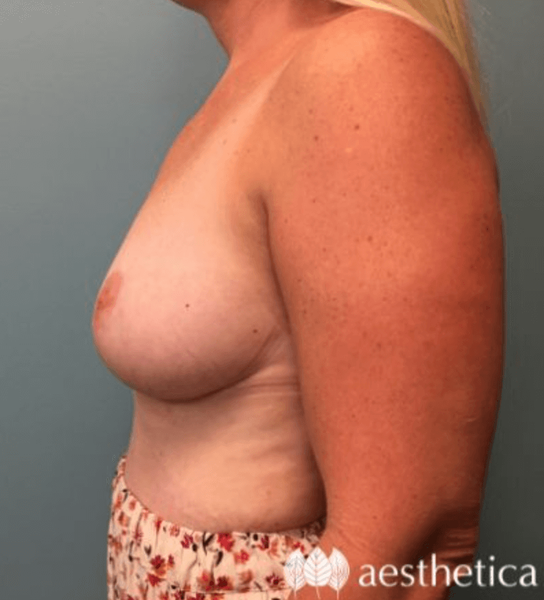 Mommy Makeover result at Aesthetica Plastic Surgery
