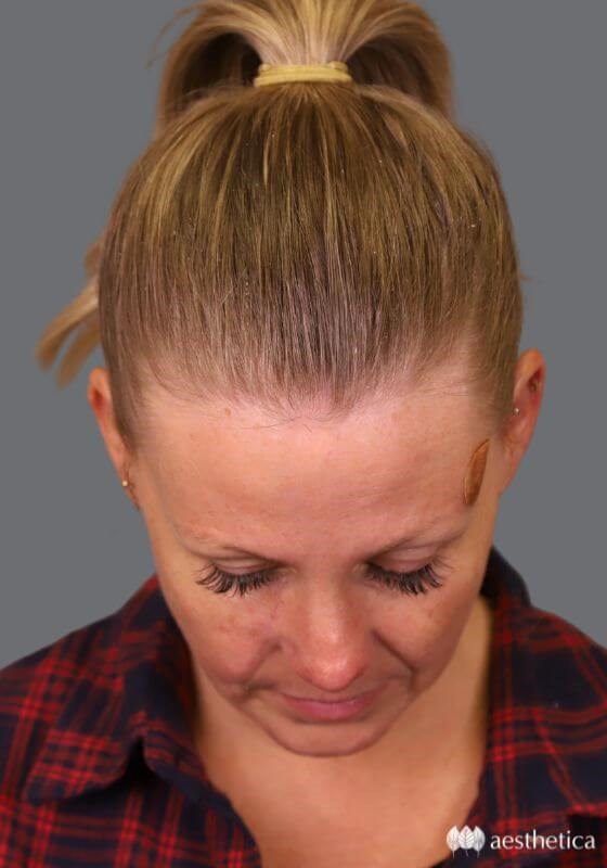 Aesthetica Plastic Surgery rhinoplasty after — Lindon, UT