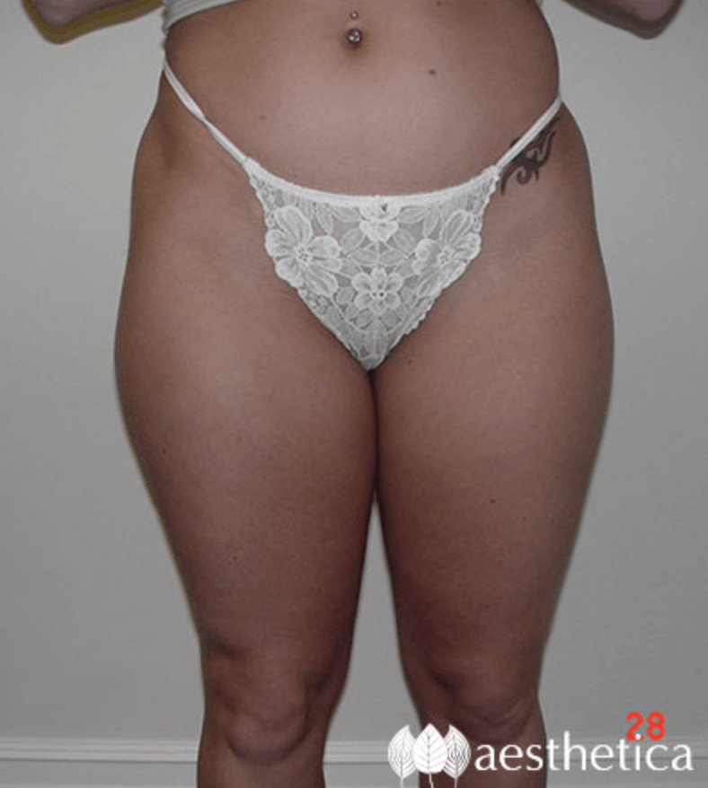 Liposuction before photo