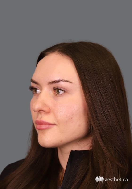 Rhinoplasty before photo
