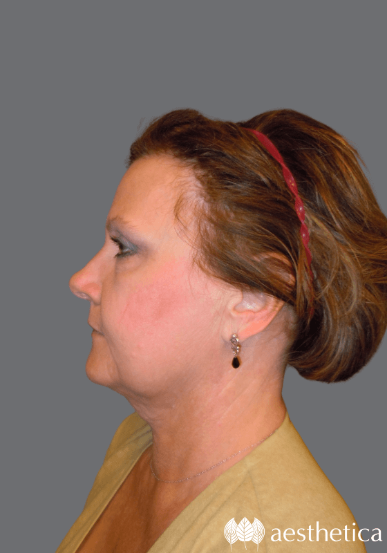 Aesthetica Plastic Surgery neck lift after — Lindon, UT