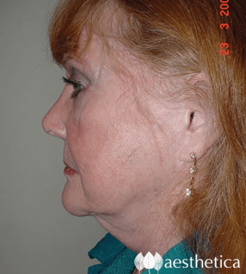 Facelift before photo