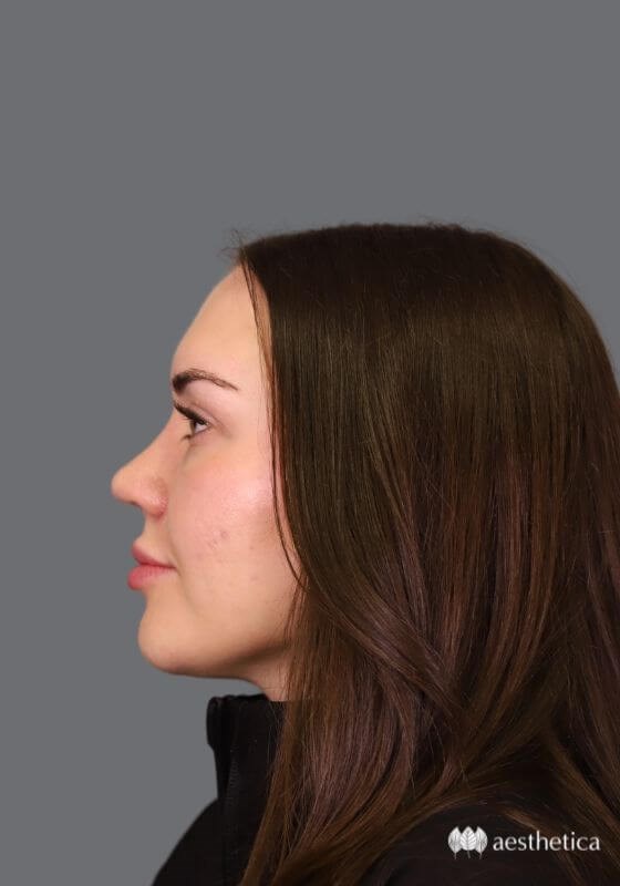 Rhinoplasty result at Aesthetica Plastic Surgery