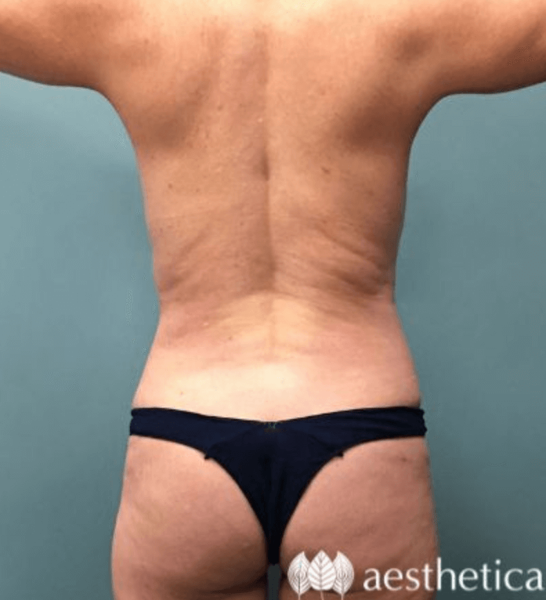 Tummy Tuck result at Aesthetica Plastic Surgery
