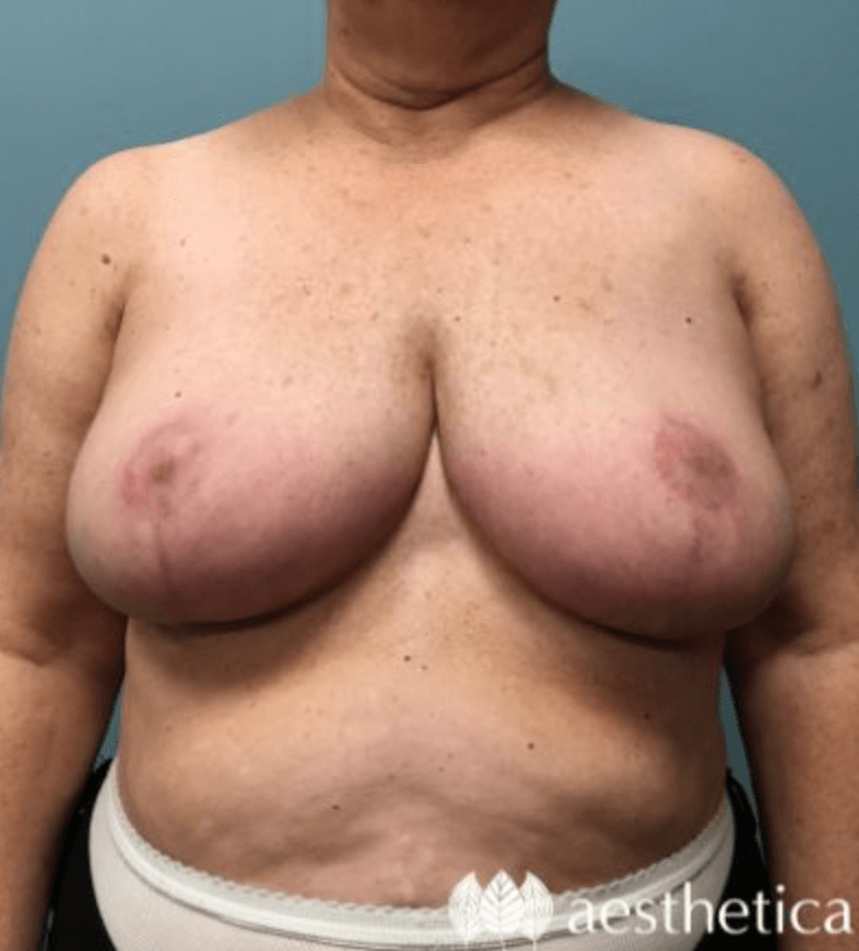 Breast Reduction result at Aesthetica Plastic Surgery