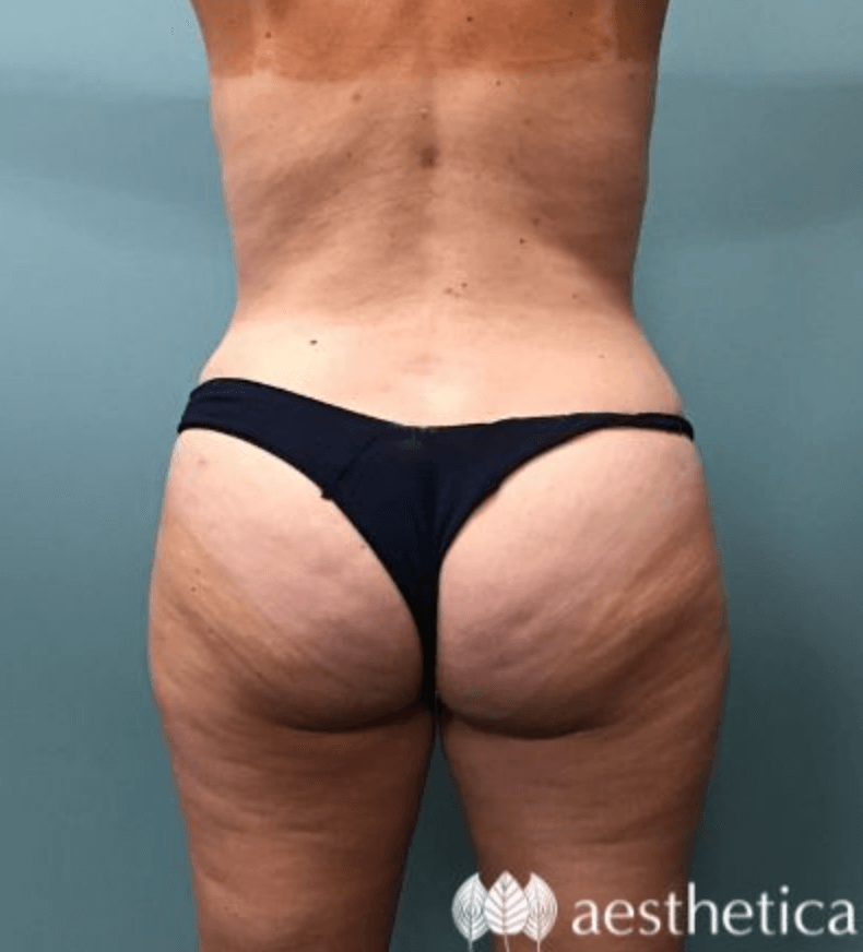 A result from Aesthetica Plastic Surgery
