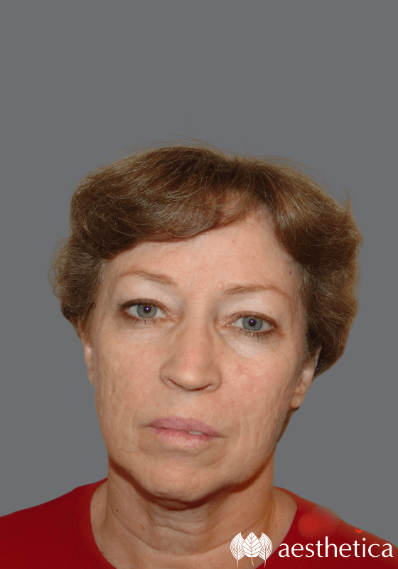 Facelift before photo