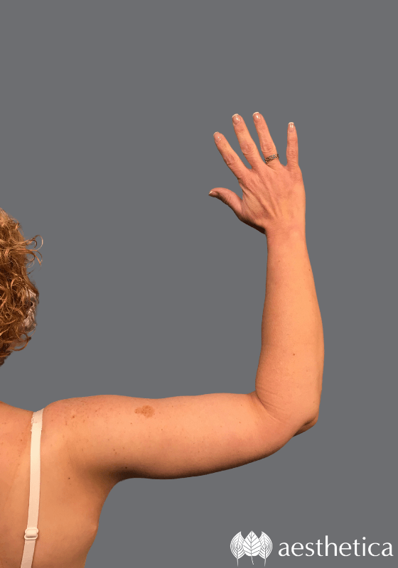Arm Lift result at Aesthetica Plastic Surgery