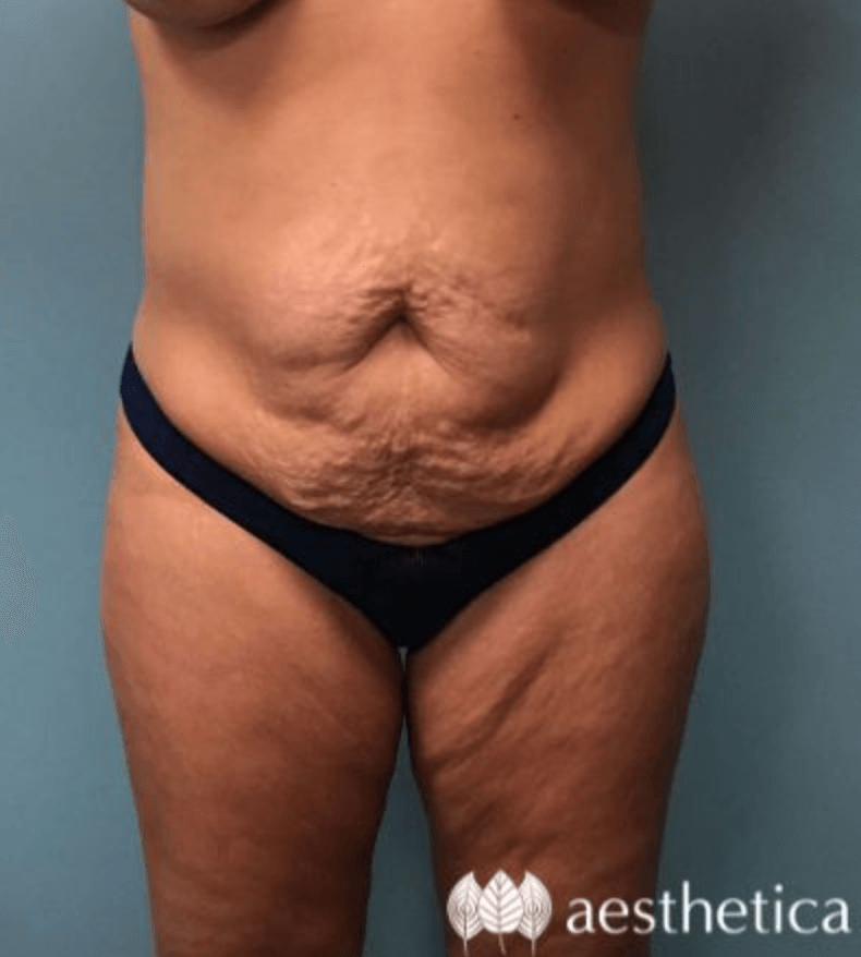 Tummy Tuck before photo