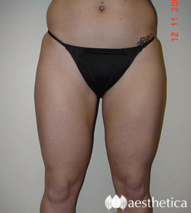 Liposuction result at Aesthetica Plastic Surgery