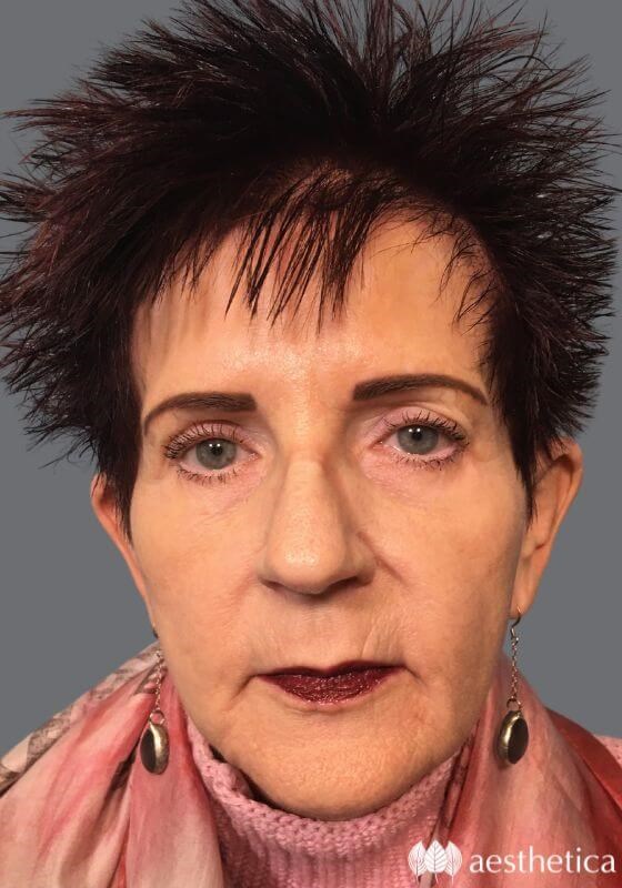 Brow Lift before photo
