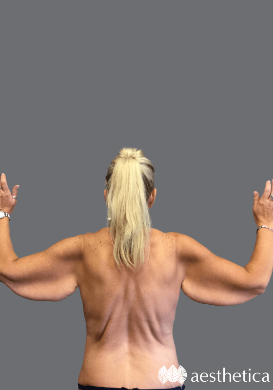 Arm Lift before photo