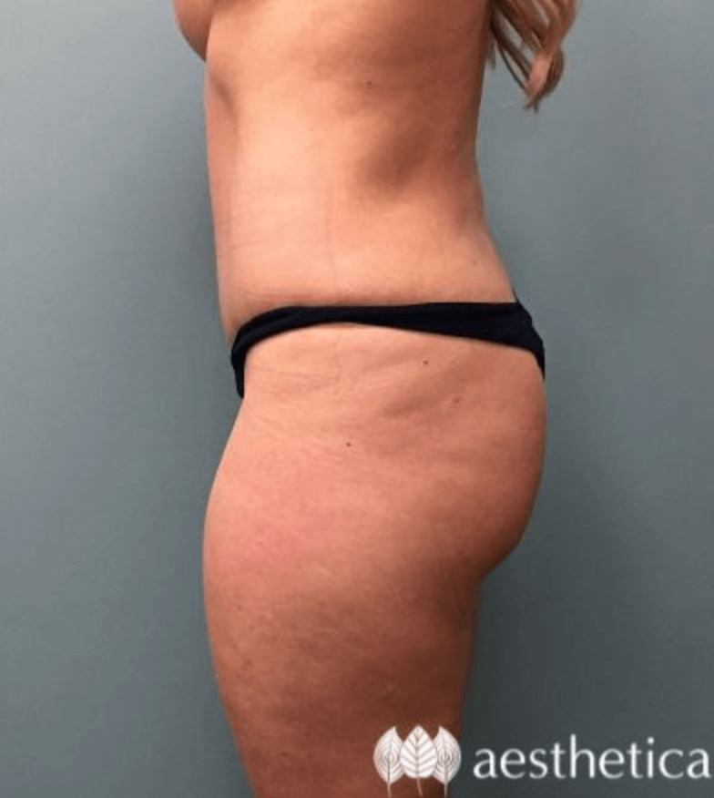 Tummy Tuck result at Aesthetica Plastic Surgery