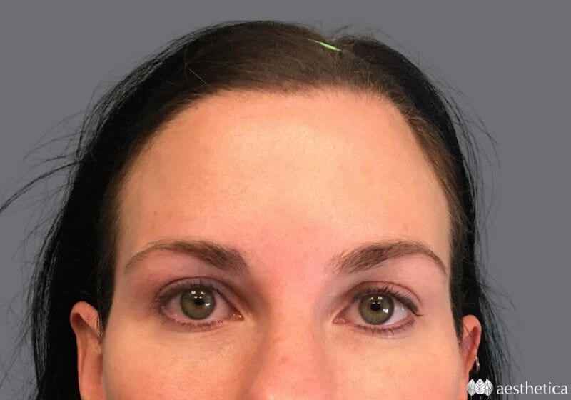 Blepharoplasty result at Aesthetica Plastic Surgery