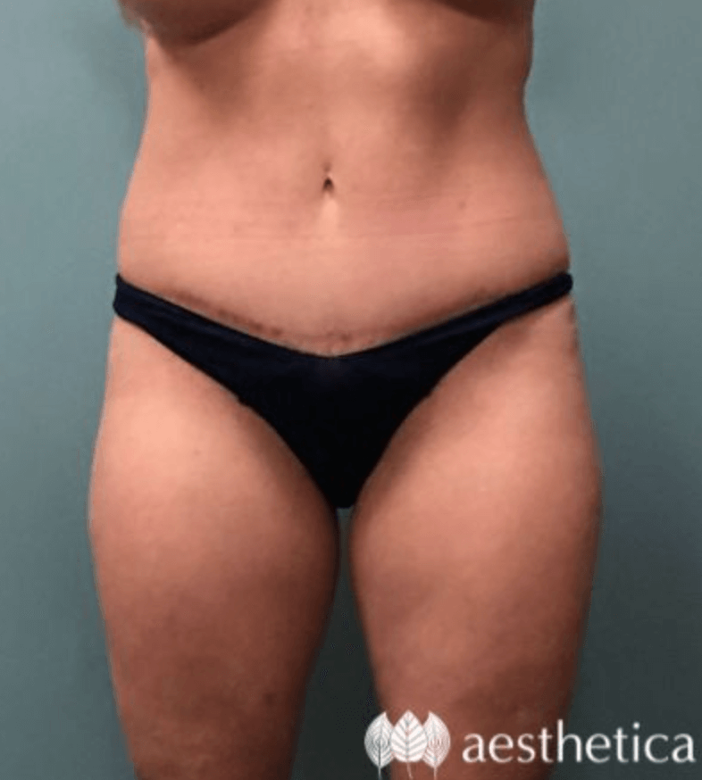 Tummy Tuck result at Aesthetica Plastic Surgery