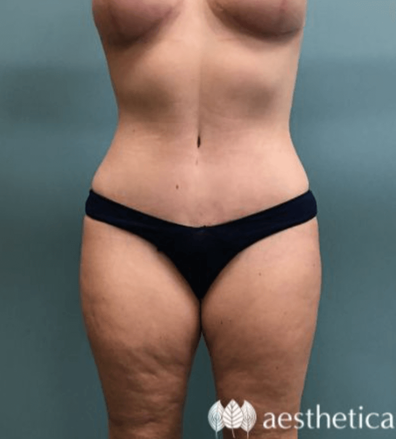 Mommy Makeover result at Aesthetica Plastic Surgery