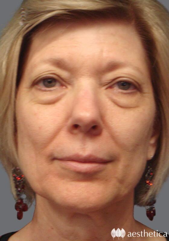 Blepharoplasty before photo