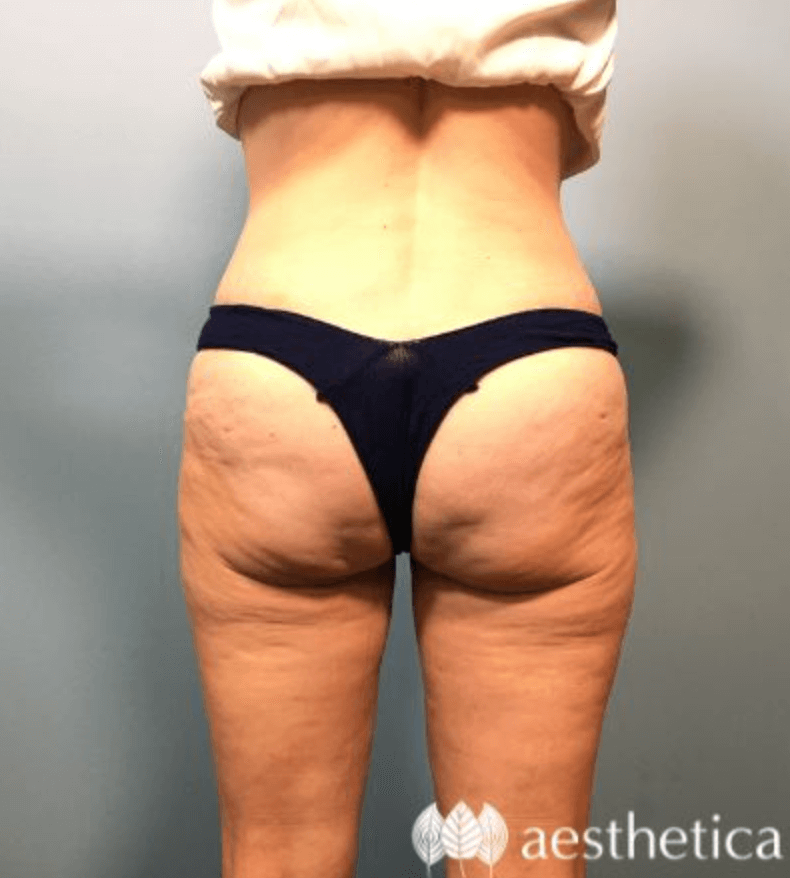 Mommy Makeover result at Aesthetica Plastic Surgery