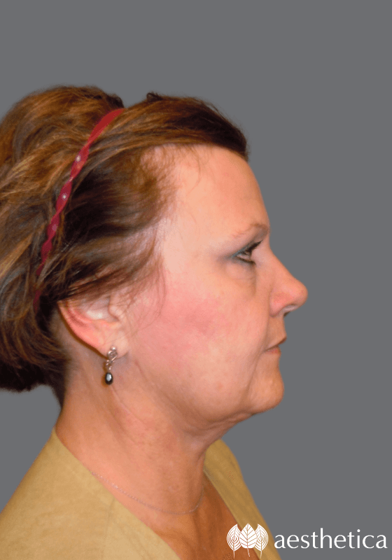 Aesthetica Plastic Surgery neck lift after — Lindon, UT