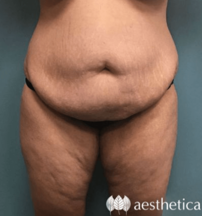 Tummy Tuck before photo