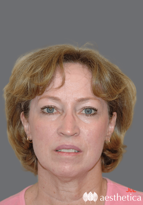 Facelift result at Aesthetica Plastic Surgery