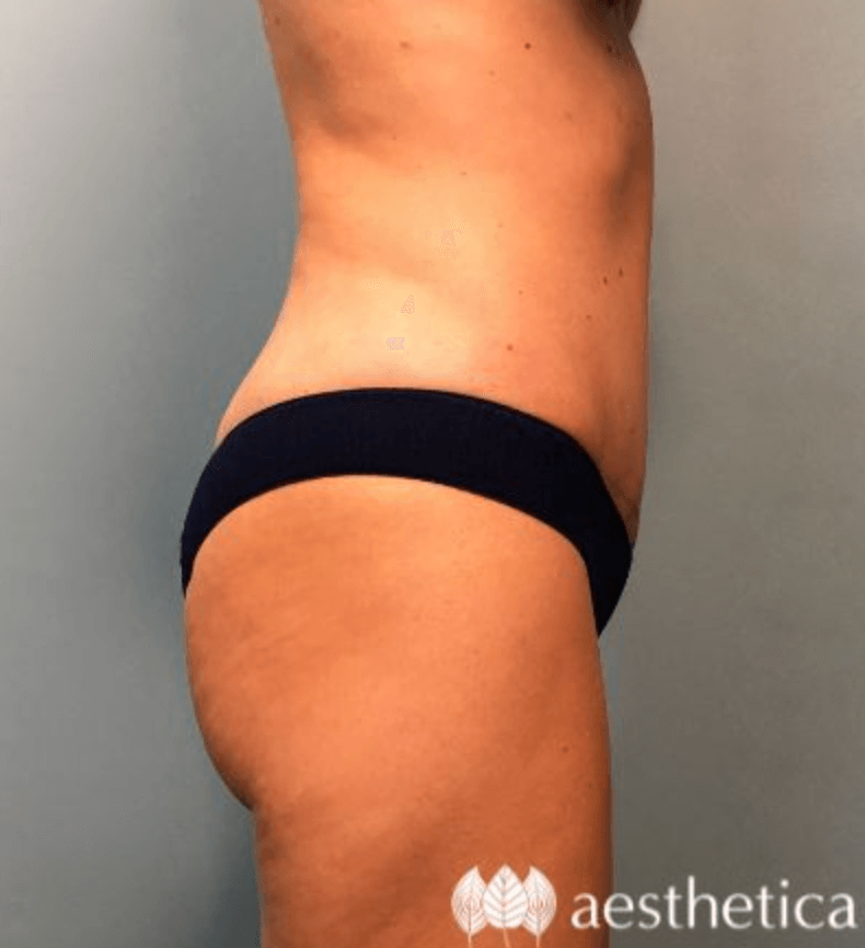 Tummy Tuck result at Aesthetica Plastic Surgery