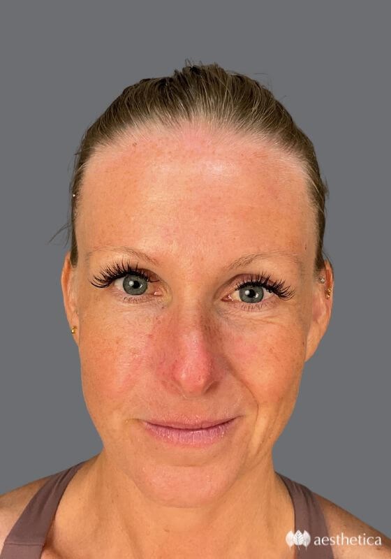 Rhinoplasty before photo