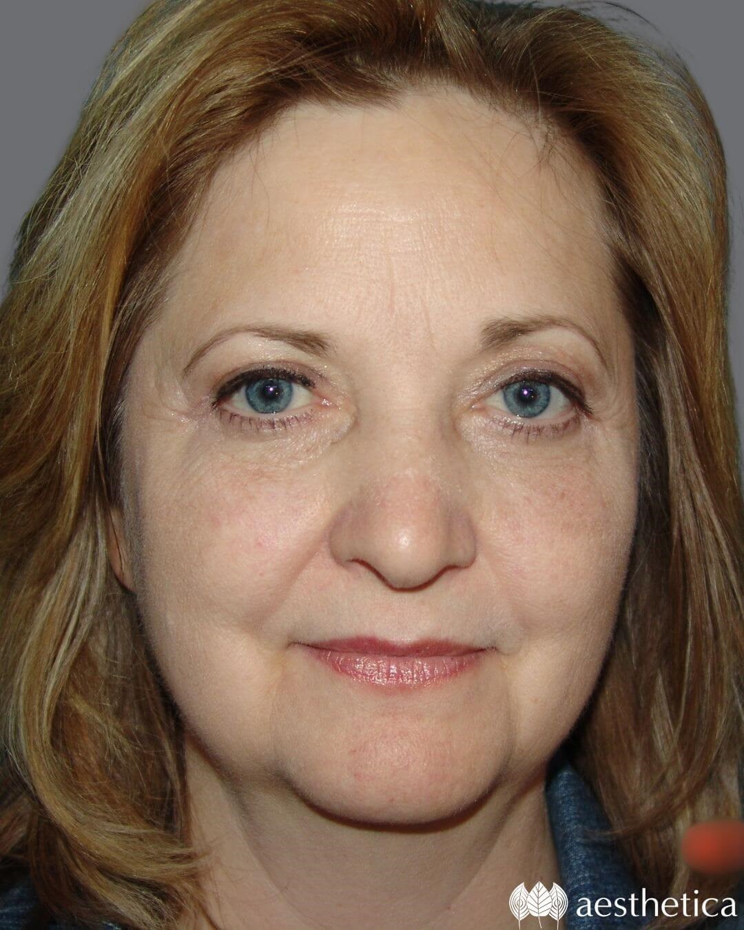 Blepharoplasty result at Aesthetica Plastic Surgery