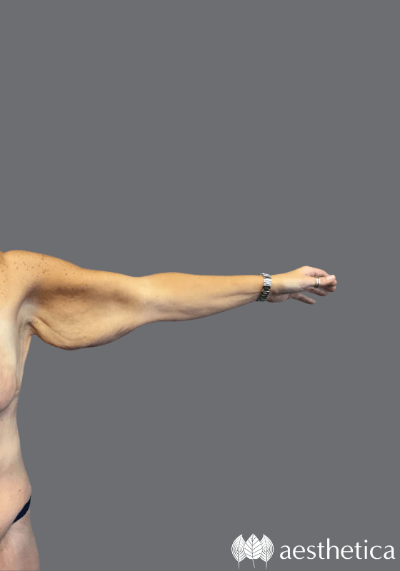 Arm Lift before photo