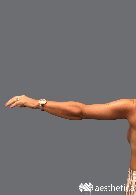 Arm Lift result at Aesthetica Plastic Surgery