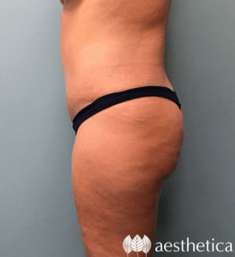 Tummy Tuck result at Aesthetica Plastic Surgery