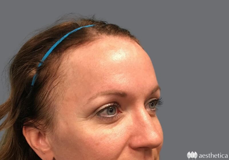 Blepharoplasty result at Aesthetica Plastic Surgery