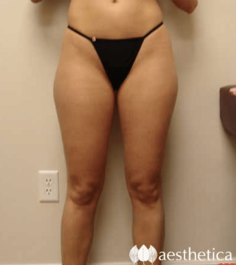 Liposuction before photo