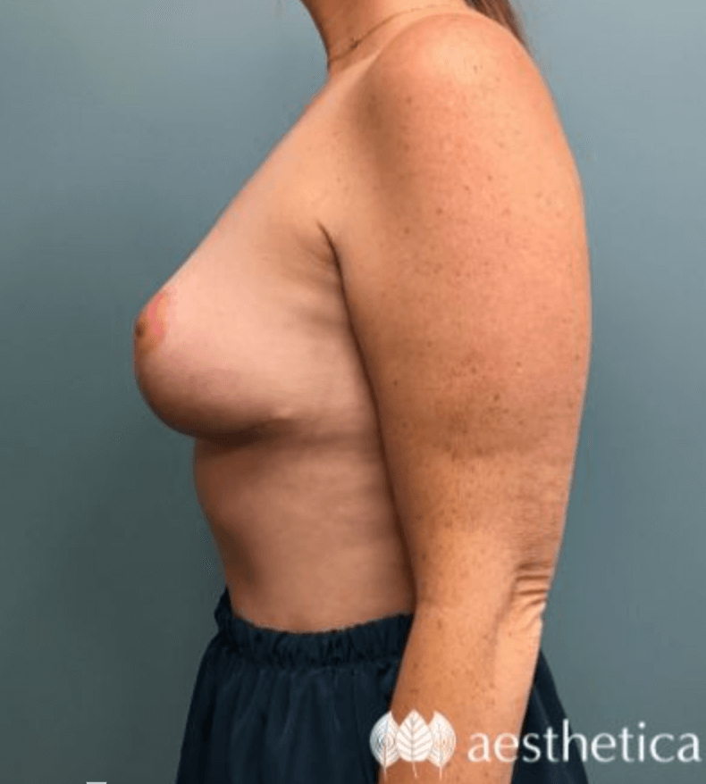 Mommy Makeover result at Aesthetica Plastic Surgery