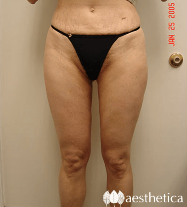 Liposuction result at Aesthetica Plastic Surgery