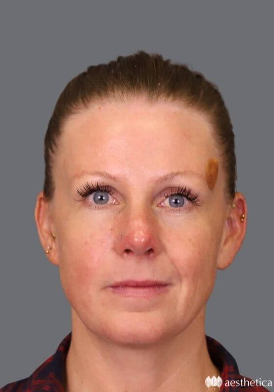 Rhinoplasty result at Aesthetica Plastic Surgery