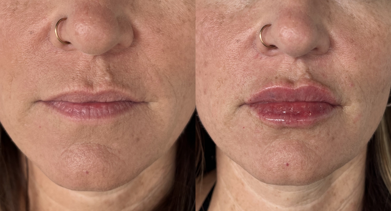 A result from Laura Trapp Aesthetics