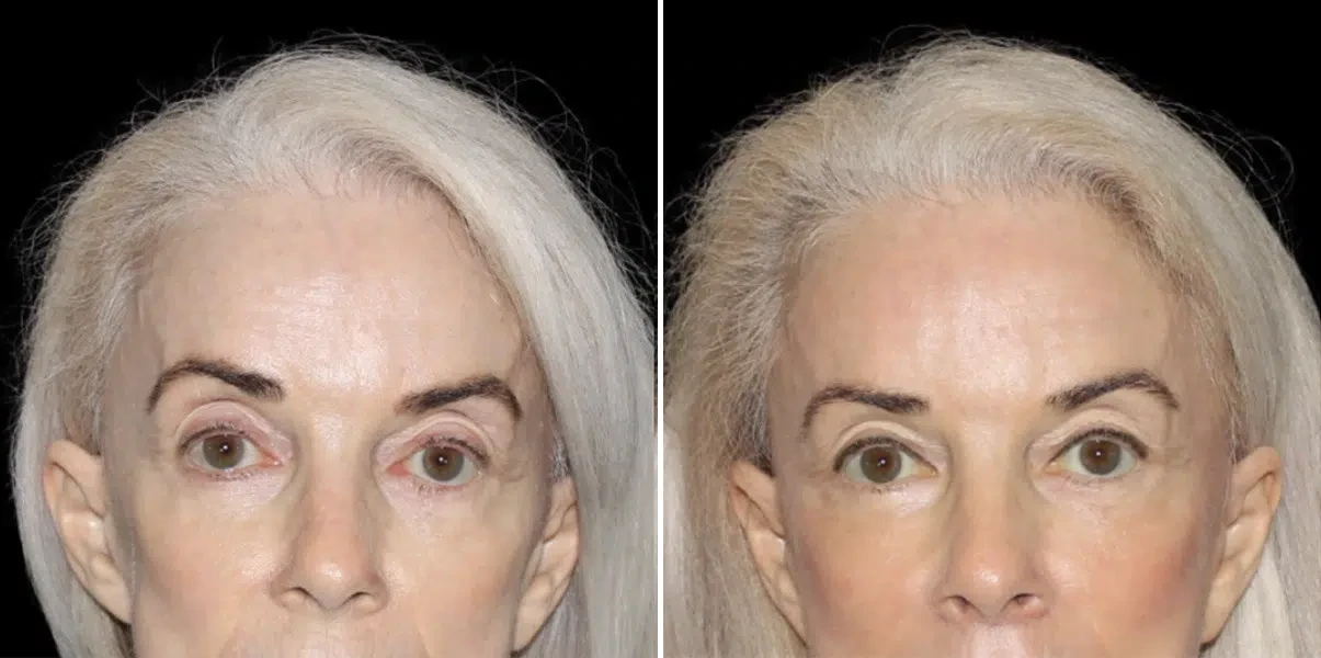 A result from SoCal Aesthetic Surgery